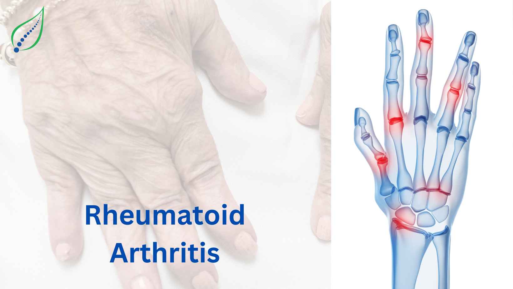 Rheumatoid Arthritis